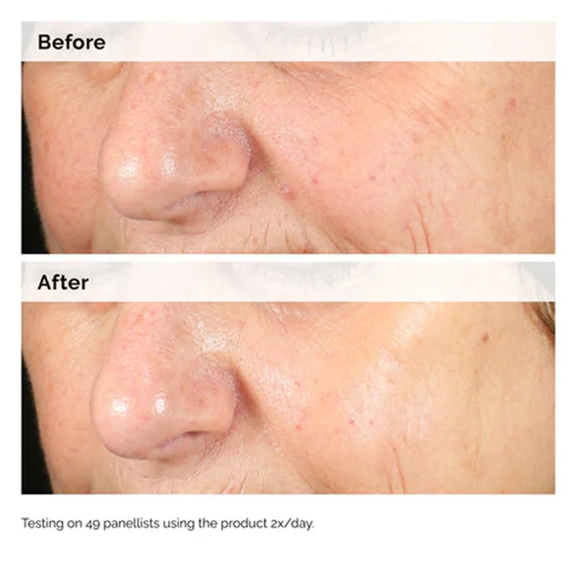 Alpha Arbutina 2% + HA 30ml Su - Azelaic Acid Serum reseña y precio