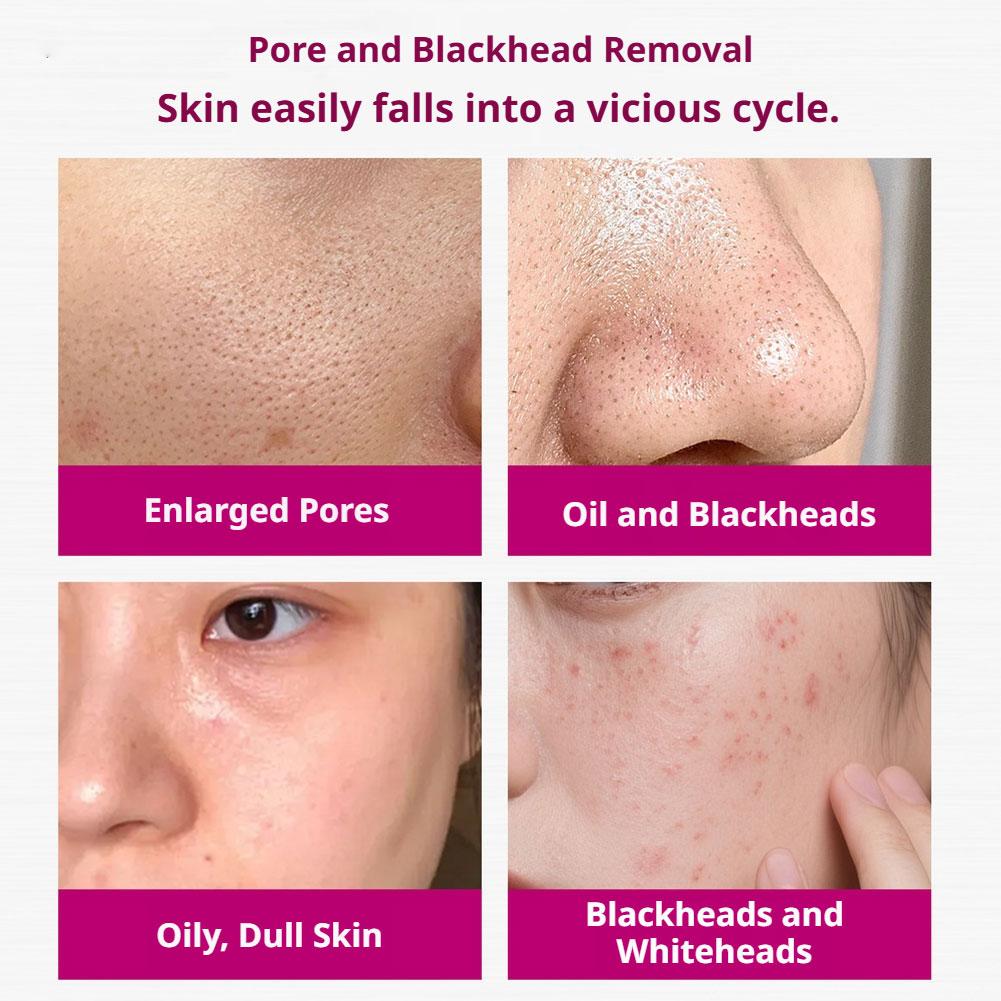 Suero con Ácido Salicílico par - Azelaic Acid Serum reseña y precio
