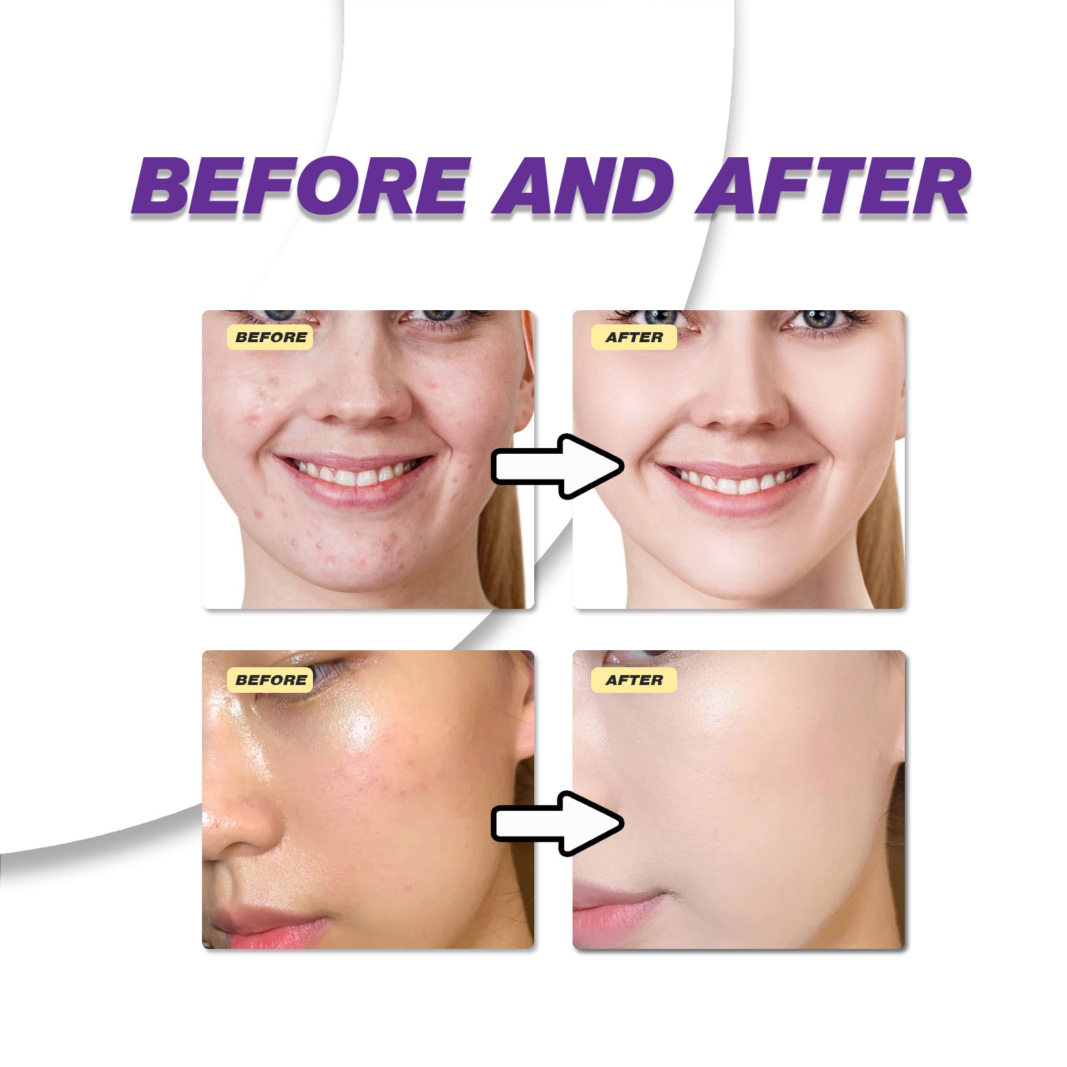 Crema de Ácido Azelaico Suave  - Azelaic Acid Serum reseña y precio