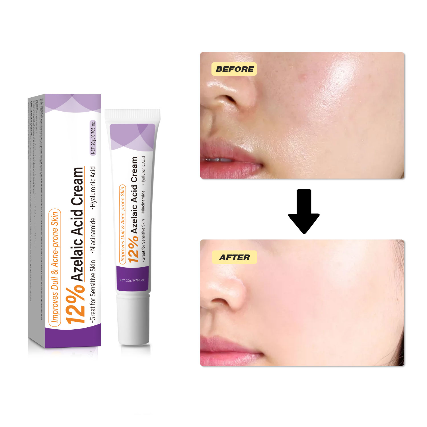 Crema de Ácido Azelaico Suave  - Azelaic Acid Serum reseña y precio
